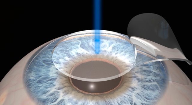Помутнение роговицы глаза (бельмо) - эффективное лечение (в т.ч. операции)