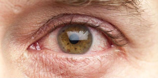 Неоваскулярная глаукома – причины и лечение
