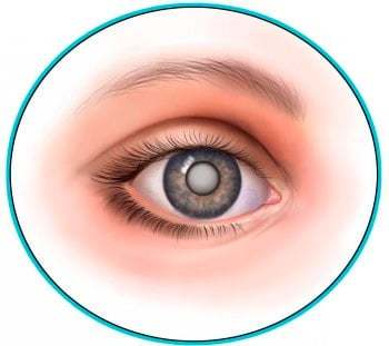 Коррекция зрения у взрослого при врожденной катаракте