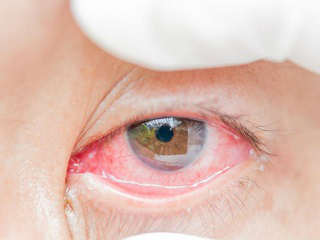 Глаукома нормального (низкого) давления