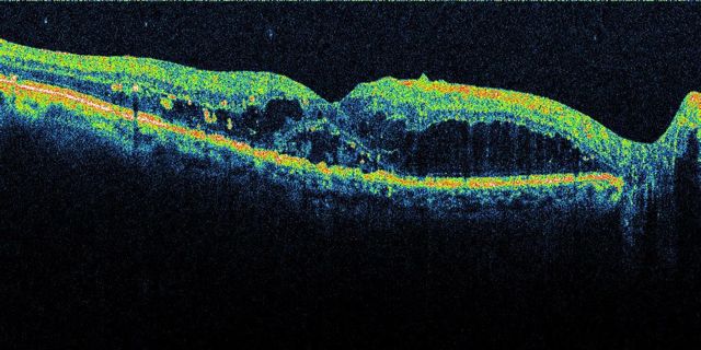 Оптическая когерентная томография (ОКТ) глаза - что означает