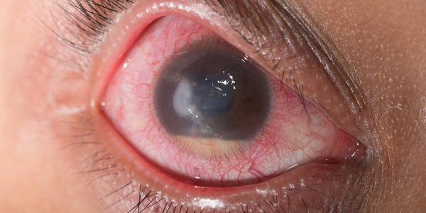 Болит глаз при глаукоме - что делать?