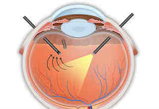 Витрэктомия глаза (микроинвазивная операция) - доступные цены, отзывы пациентов после лечения