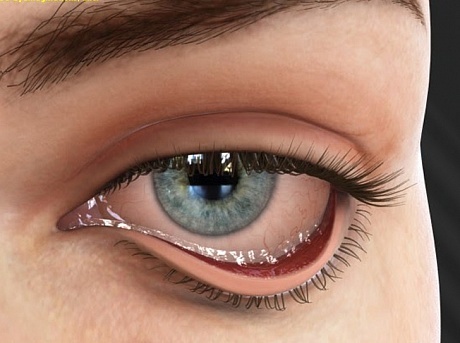 Заворот века глаза у человека (энтропион) - причины и эффективное лечение (операция блефаропластики)