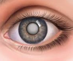 Лечение катаракты на фоне помутнения роговицы и диабета