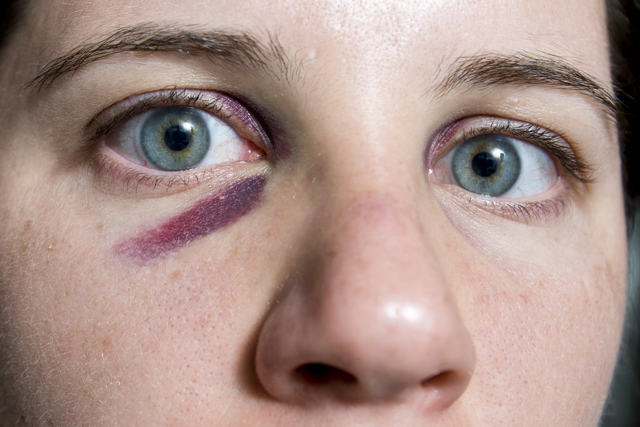 Травма глаза - после удара глазное яблоко не двигается