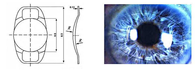 Зрение и галоэффект после установки трифокального искусственного хрусталика