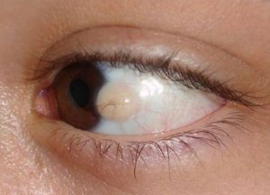 Киста конъюнктивы глаза: причины, симптомы и эффективные методы лечения заболевания