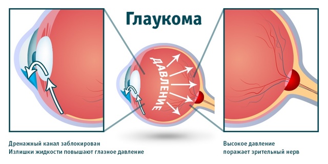 Вторичная глаукома: причины, лечение и классификация