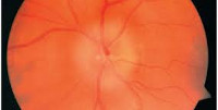 Постоклюзионная атрофия нерва и ишемическая нейрооптикопатия глаза