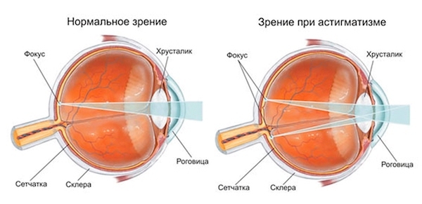 Очки при близорукости и астигматизме - какие стекла нужны