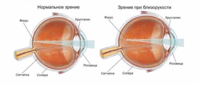 После применения очков с дырочками резко ухудшилось зрение
