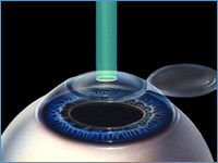 Восстановление зрения при близорукости высокой степени - факичные иол или лазер