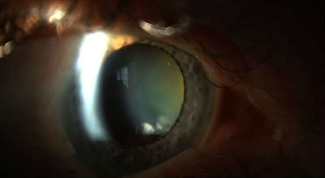 Факосклероз хрусталика глаза: причины, симптомы и эффективные методы лечения заболевания