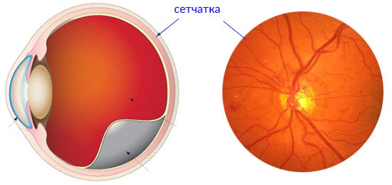 Ангиоидные полосы сетчатки глаза - причины и лечение