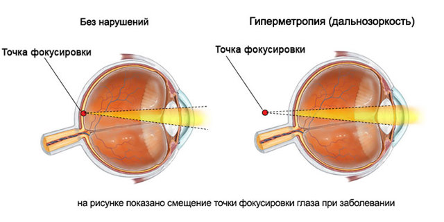 Коррекция дальнозоркости (гиперметропии) - очковая, контактная, лазерная коррекция
