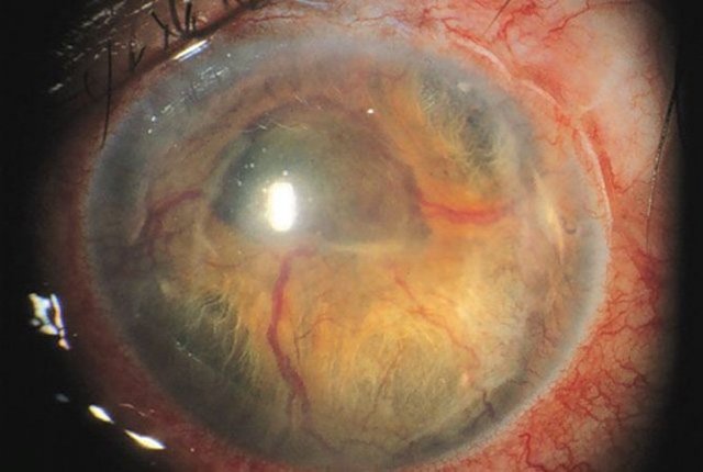 Неоваскулярная глаукома – причины и лечение