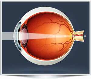 Смешанный астигматизм обоих глаз - возможна ли лазерная коррекция зрения?