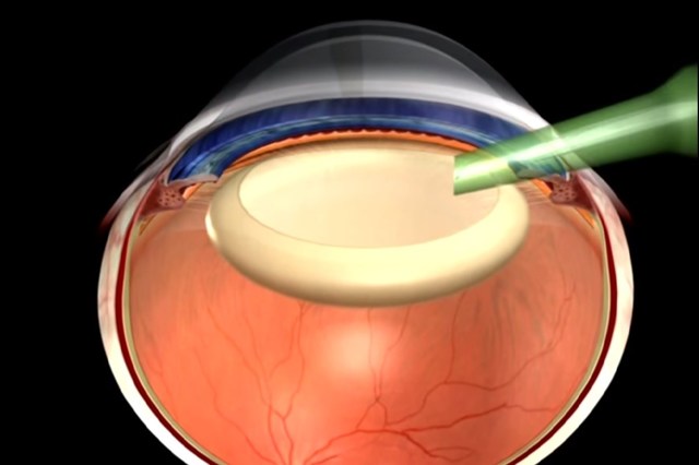 EDOF ИОЛ - имплантация в один глаз при катаракте