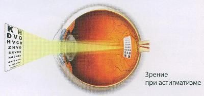 Лучший хрусталик (ИОЛ) при астигматизме в молодом возрасте