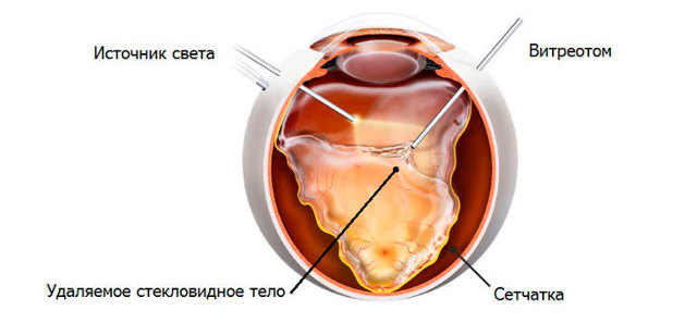 Подвывих (сублюксация) и вывих (люксация) хрусталика в стекловидное тело глаза