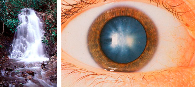 Удаление мутного хрусталика (катаракты) при глаукоме