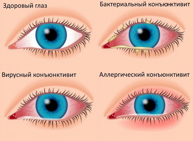 Симптомы (признаки) конъюнктивита глаз у детей и взрослых