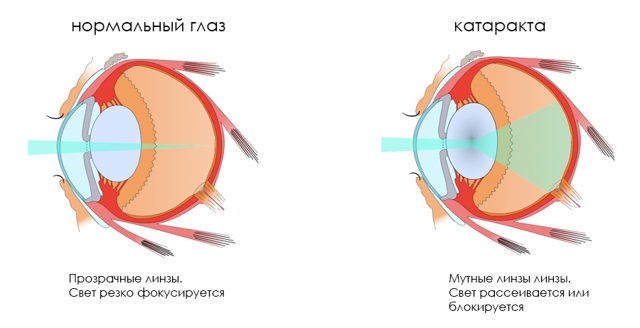 Полярная катаракта - что это такое (особенности, причины и лечение)