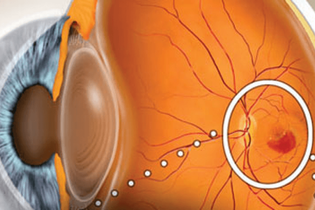 Диета при макулодистрофии глаза (ВМД)