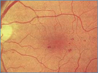 Диабетическая ретинопатия на единственном глазу