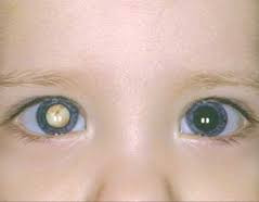 Вторичная катаракта у ребенка при врожденной катаракте