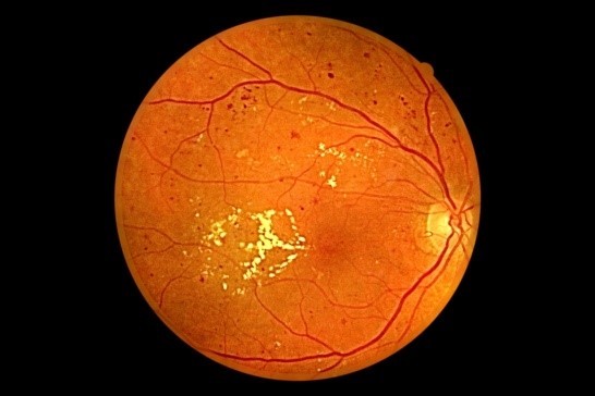 Диагноз: миопия, дистрофия и отслойка сетчатки, катаракта
