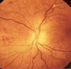 Ретинопатии сетчатки глаза