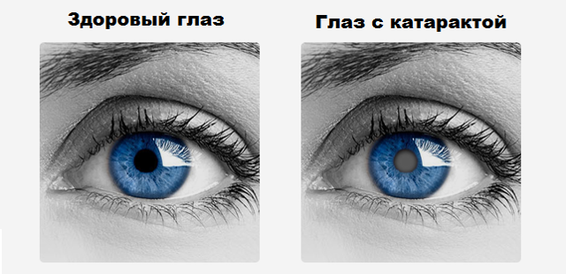 Как улучшить зрение при катаракте