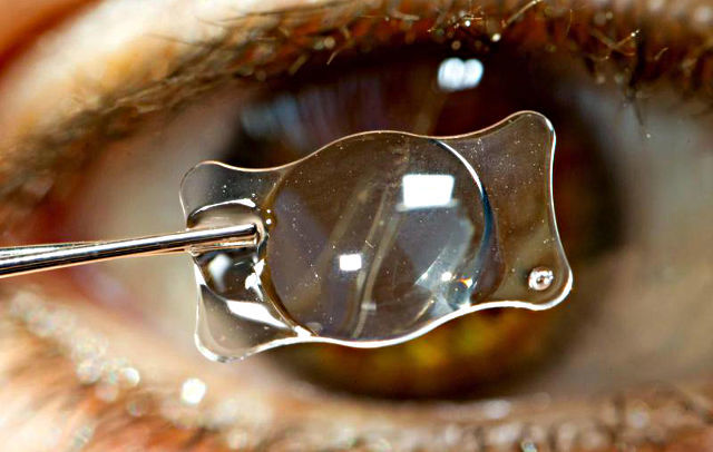 Замена хрусталика при катаракте, глаукоме и астигматизме - какая ИОЛ лучше?