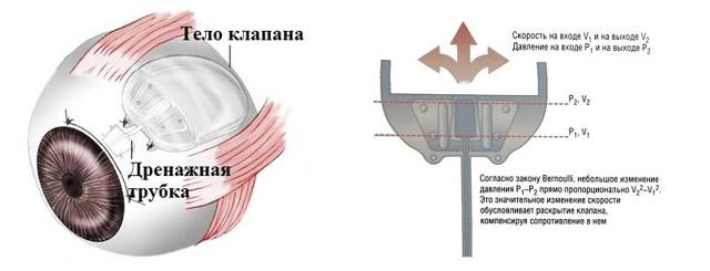 Не лазерные (ножевые) операции при глаукоме - установка дренажа