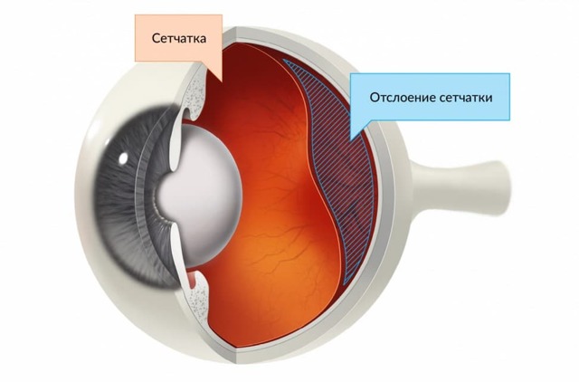 Заболевания роговицы глаза: воспалительные, дистрофические и врожденные и их лечение
