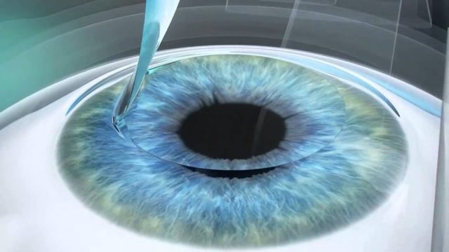 Травма глаза разбитыми очками - как восстановить зрение