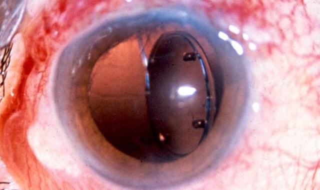 Опалесценция влаги передней камеры глаза после удаления катаракты