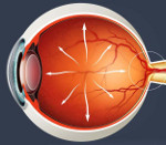 Артифакия обоих глаз и глаукома - что делать