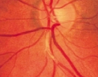 Гипертонический ангиослероз сетчатки глаза - развитие, симптомы, профилактика, лечение