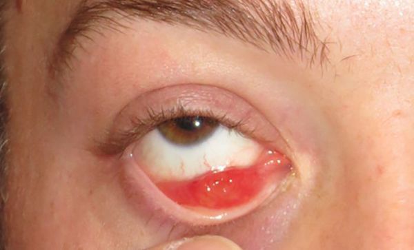 Можно ли вылечить внутренний ячмень на глазу без операции?