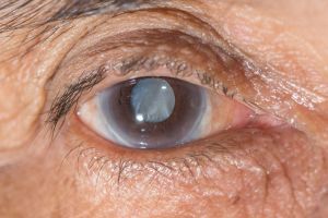 Профилактика глаукомы и катаракты - как сохранить зрение?