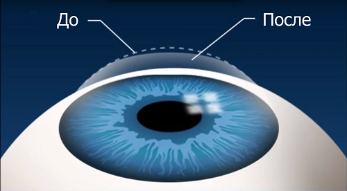 Лазерная коррекция зрения и ревматоидный артрит