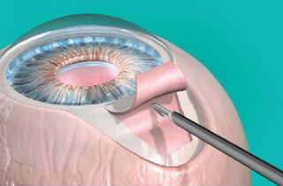 Не лазерные (ножевые) операции при глаукоме - установка дренажа