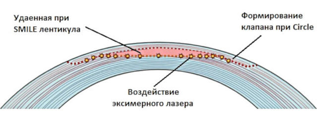 Улучшить зрение при тонкой роговице - лазерная коррекция или ИОЛ