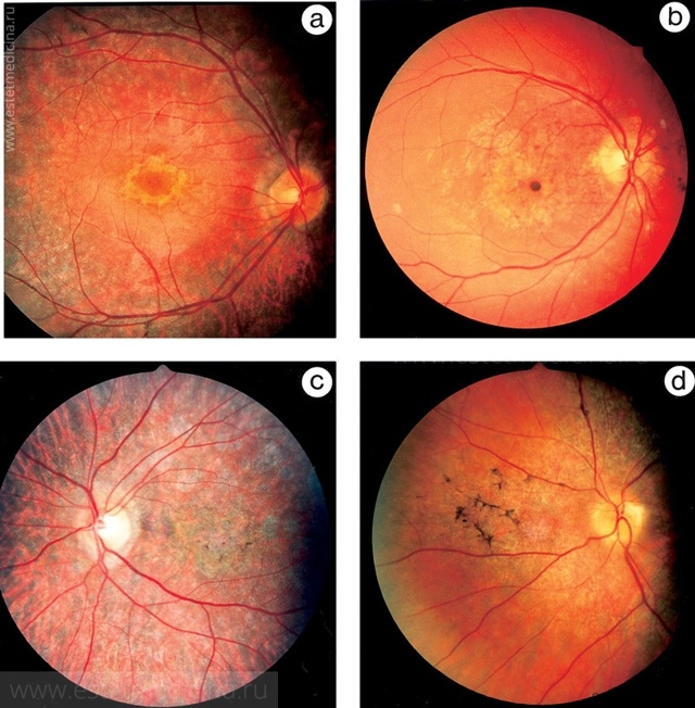 Витрэктомия глаза (микроинвазивная операция) - доступные цены, отзывы пациентов после лечения