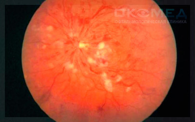 Лазерные операции при пигментной дистрофии сетчатки глаза