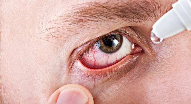 Аллергия на глазах и коже век - причины, симптомы и эффективное лечение (средства). Московский офтальмологический центр.