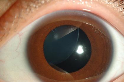 Неудачная операция по удалению катаракты - витрэктомия и подшивание ИОЛ
